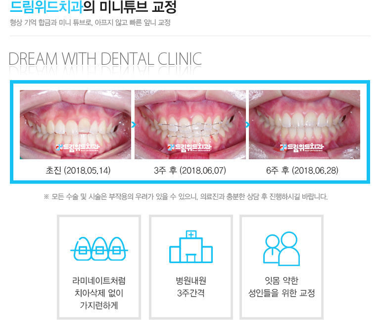 라미네이트처럼 치아삭제 없이 가지런하게
	병원내원 3주간격
	잇몸 약한 성인들을 위한 교정