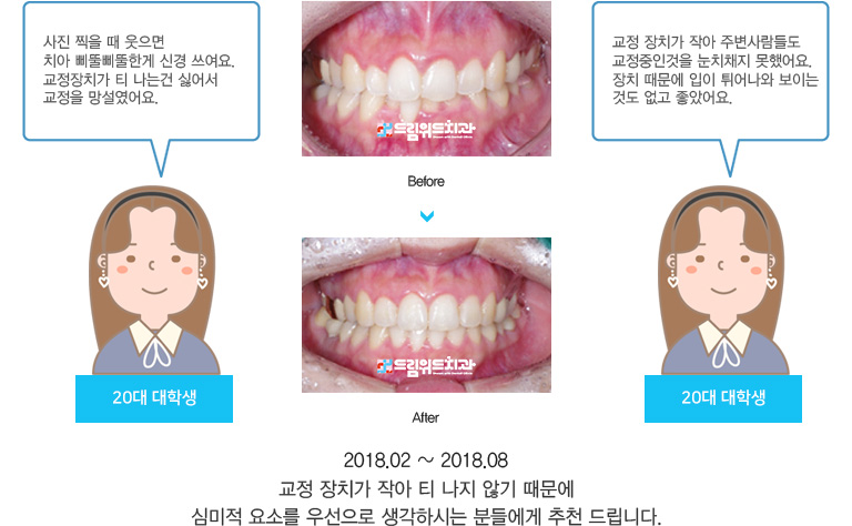 교정 장치가 작아 티 나지 않기 때문에
심미적 요소를 우선으로 생각하시는 분들에게 추천 드립니다.
