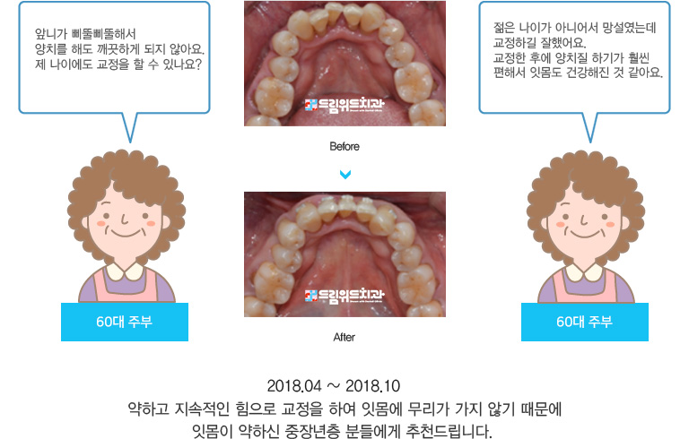 약하고 지속적인 힘으로 교정을 하여 잇몸에 무리가 가지 않기 때문에
잇몸이 약하신 중장년층 분들에게 추천드립니다. 